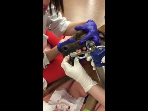 Freezing (cryotherapy) warts (viral papillomas) in a Dog
