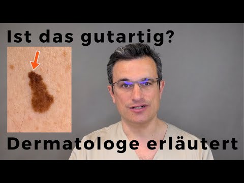 Wie erkenne ich, ob ein MUTTERMAL GUTARTIG ist? Der Dermatologe Dr. Kasten erklärt, was wichtig ist