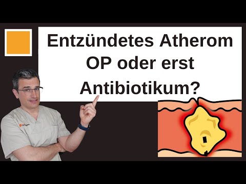 Entzündetes Atherom: OP oder erst nur Antibiotikum? Hautarzt erklärt | Dr. Kasten Hautmedizin Mainz