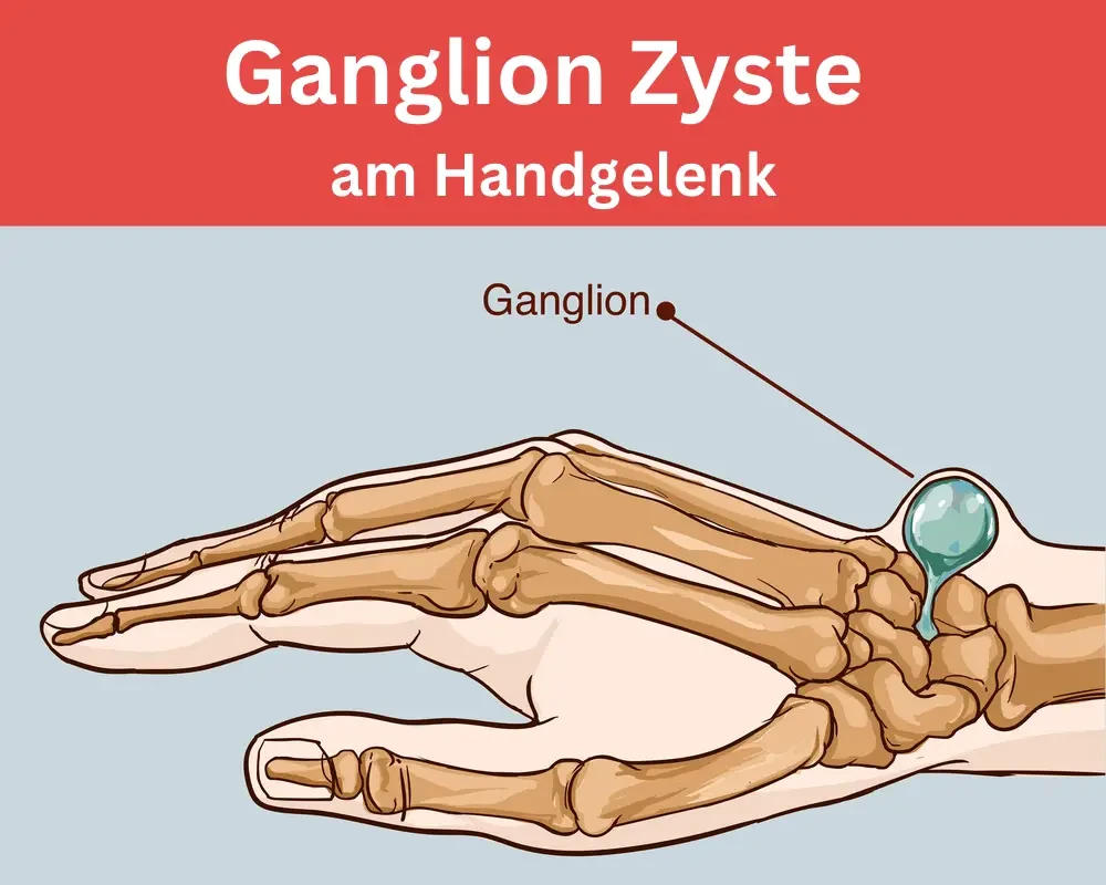 ganglion zyste am menschlichen handgelenk