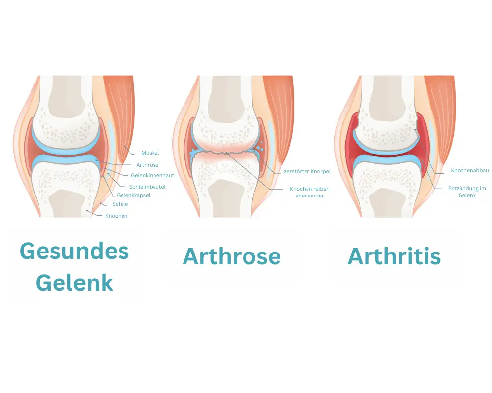 arthrose und arthritis